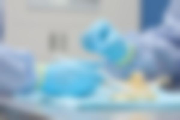 2、陈烈医生鼻整形术后持久自然