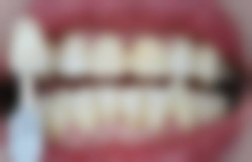 乌鲁木齐牙博士口腔牙冠修复咋样？治疗过程与医生技术展现