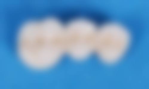 牙冠修复成效显著，乌鲁木齐牙博士口腔值得信赖