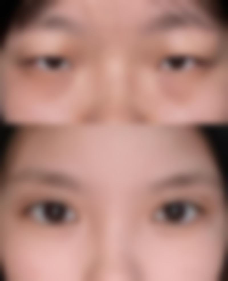 打瘦肩针的其他注意事项