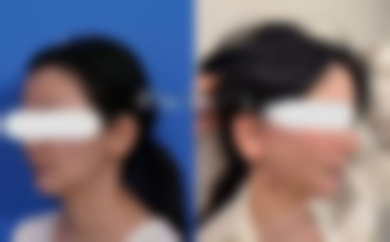 不同类型除皱针对面部护理的影响