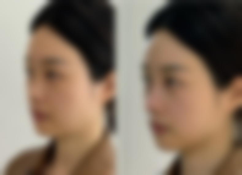 注射隆胸对身体有害吗？不同材料风险不同，奥美定危害大还可能致癌