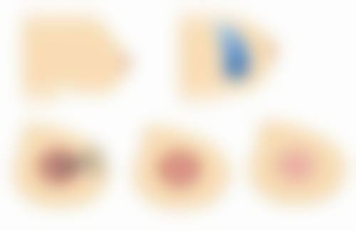 切包皮不一定能延长性生活的情况有哪些