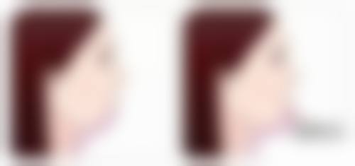 补充睡眠能消除眼袋吗？睡眠不足型或可缓解，其他成因还需多法应对 