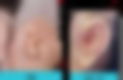 总结自体脂肪丰臀后坐着的时间