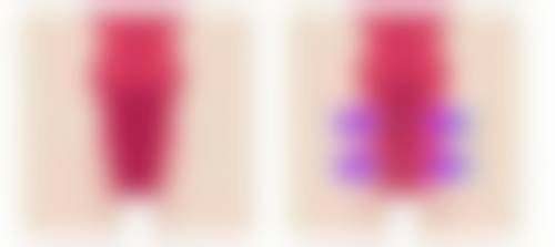 如何正确丰太阳穴太阳穴塌陷？原因、好处、方法及术后注意事项一文给你讲清