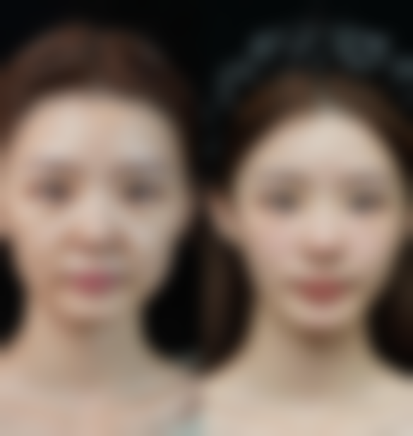 种植头发需要多久？手术一般3 - 8小时 看到最终效果通常需6 - 12个月