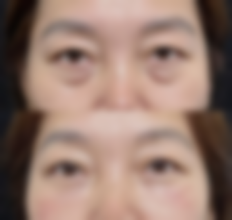 植发后多久能长出浓密的头发