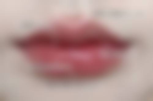 打针隆鼻有哪些危害？感染、形态不佳、过敏等多种风险了解一下