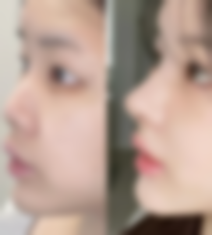 注射瘦脸针有副作用吗:总结