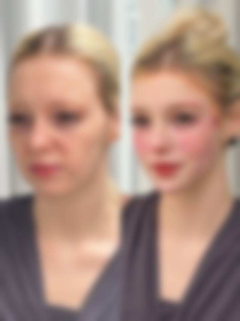 哪些因素会影响肥胖抽脂手术的危害程度