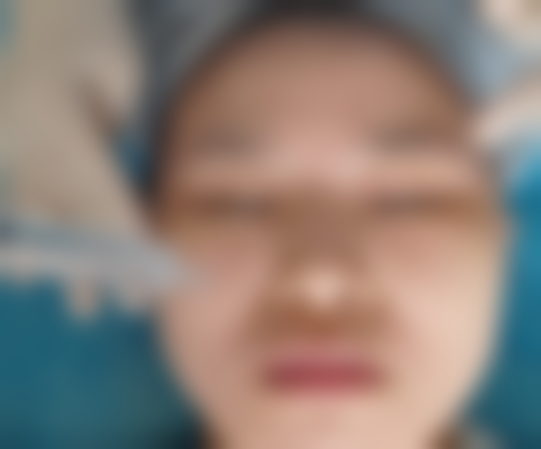 北京圣嘉新医疗美容医院杏枝山治疗后成效如何？