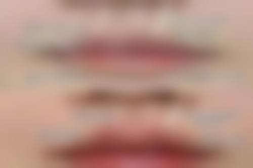 进口瘦脸针和国产瘦脸针的价格差距大吗？