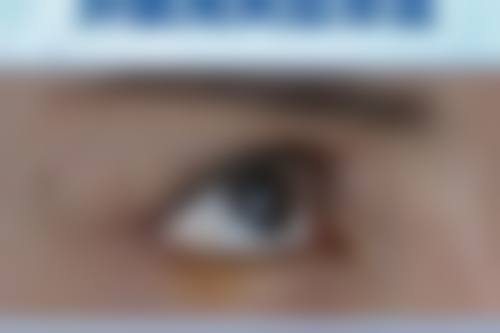 注射溶脂针去除咬肌