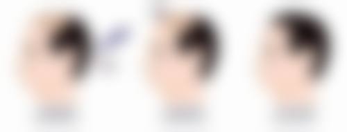 选择医院修复脸部凹陷疤痕的要点