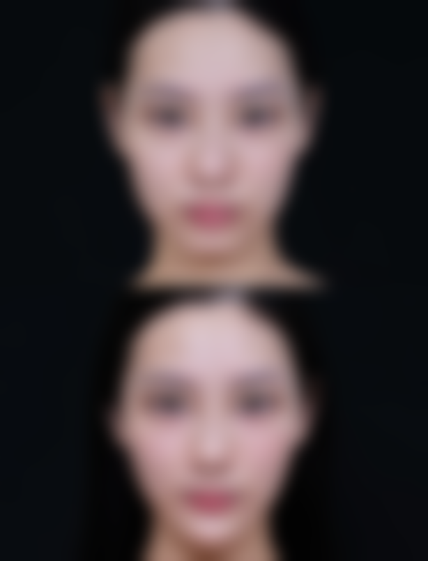 生长因子注射修复脸部凹陷疤痕