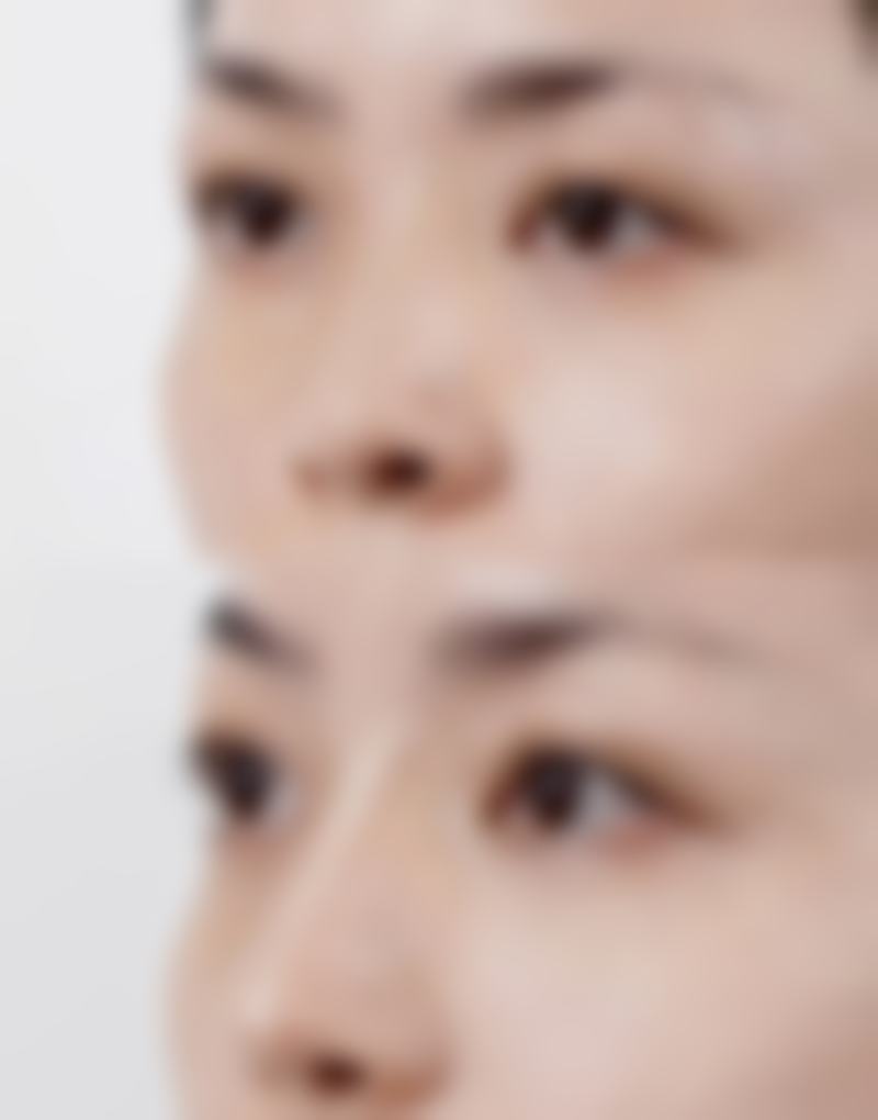 美白针的成分及成效