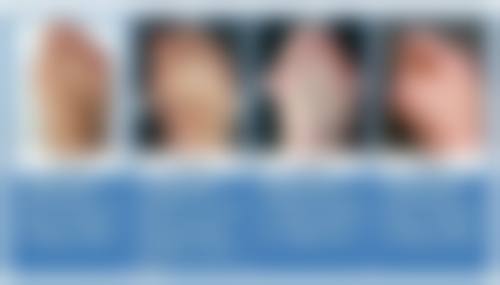 影响三点定位双眼皮维持时间的因素有哪些