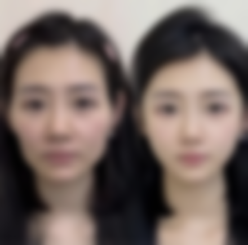 颈部吸脂手术的适用人群和禁忌人群