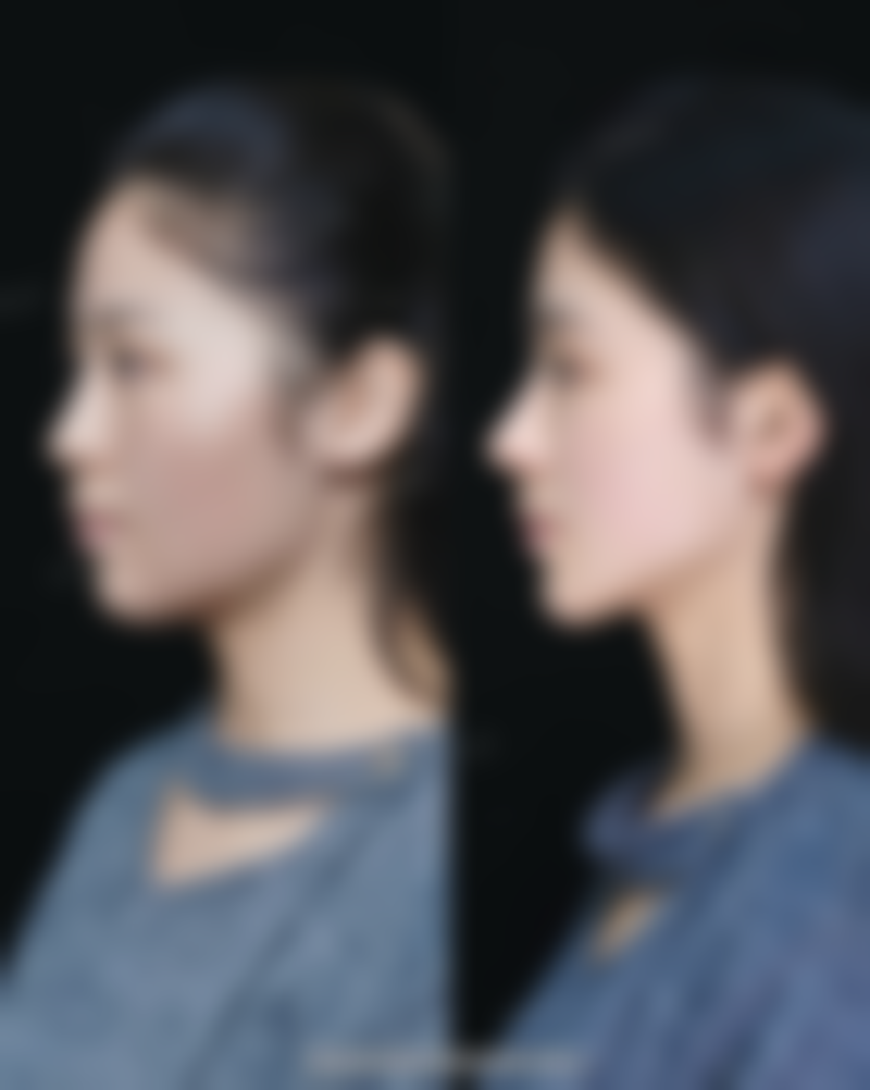 杭州雍禾植发口碑如何？