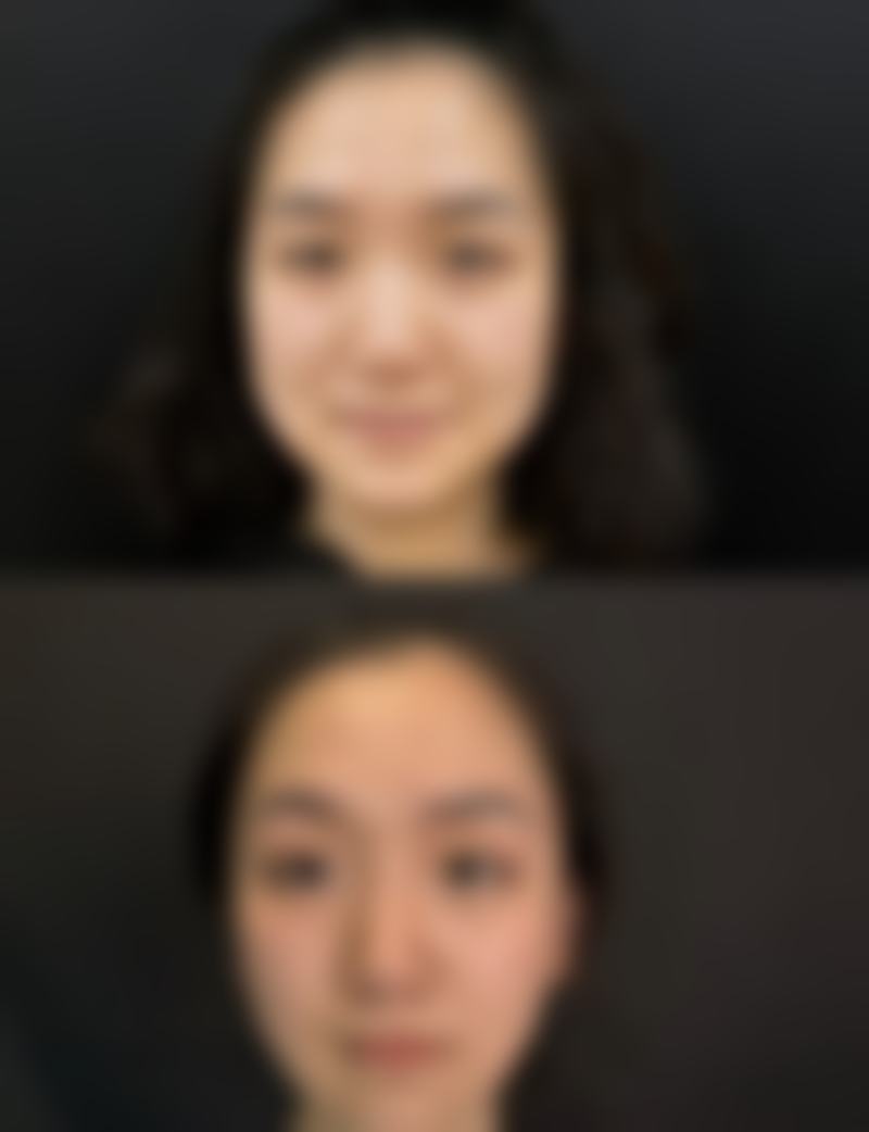 下颌骨骨折和错位的风险高吗