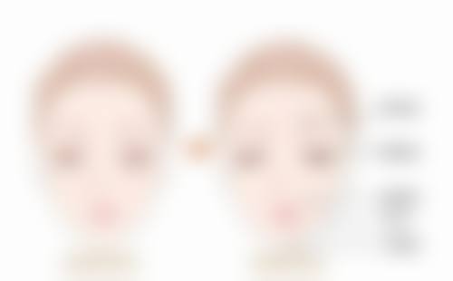 假体植入如何可以丰太阳穴