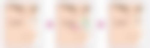 丰太阳穴需要多少？不同方式费用大不同且受地区、个人情况、医院医生影响 