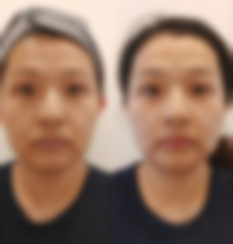 打针隆胸后续可能出现的问题