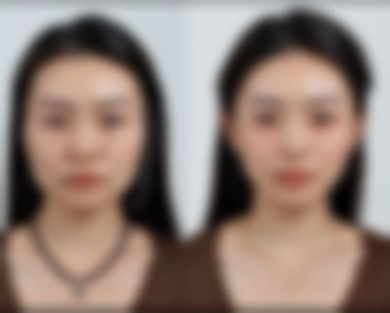 去除眼袋手术哪家好不？综合考量多因素 各地优质医院任你选