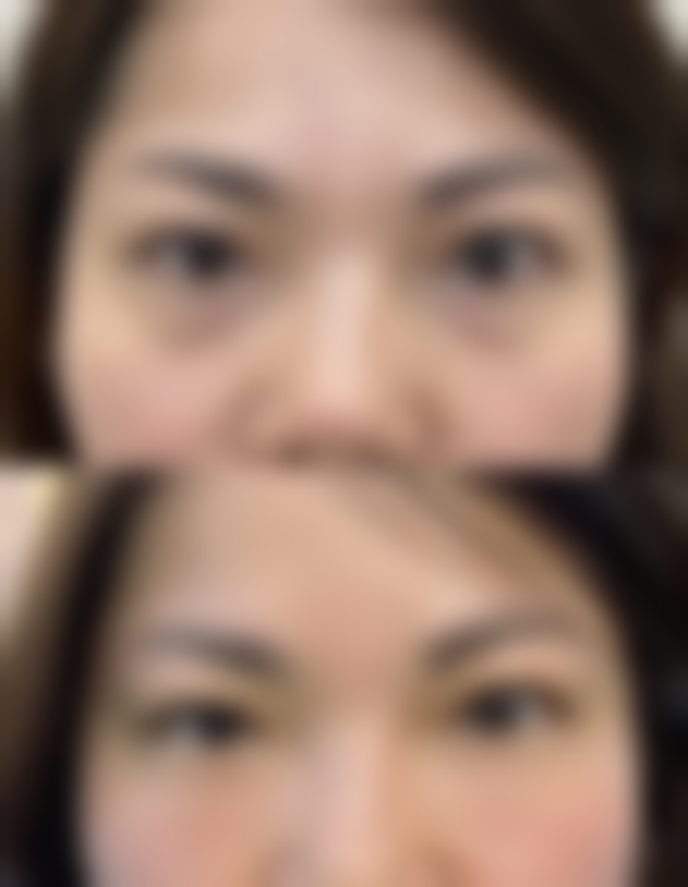 总结:打美白针会有什么副作用