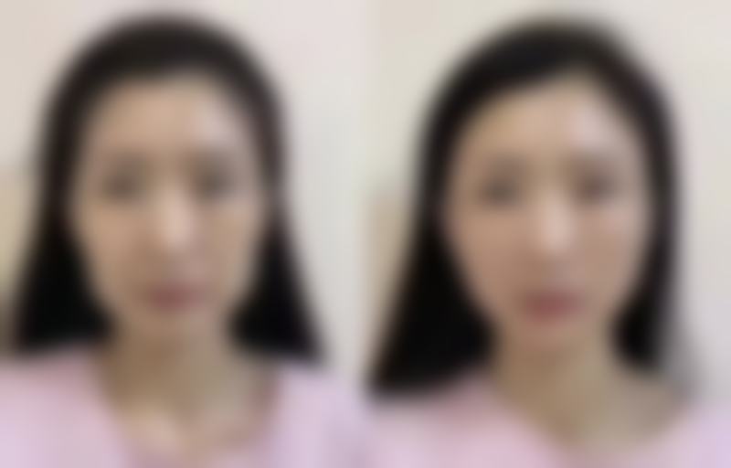 选择嘴巴整容的注意事项