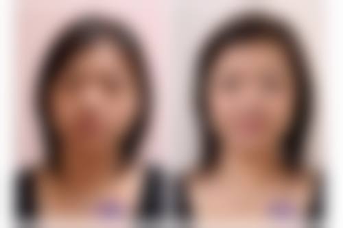 不适宜人群打正规瘦脸针的注意事项