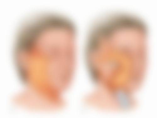 疤痕疙瘩修复什么方法好 药物、手术、放疗、激光、压力疗法哪种更适合你