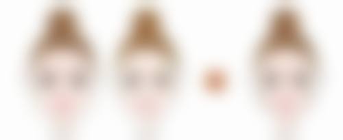 胶原蛋白注射填充太阳穴的情况