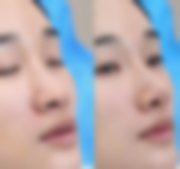 种植的头发一个月能长多少？常见0.5至1厘米 术后如何护理促生长？ 