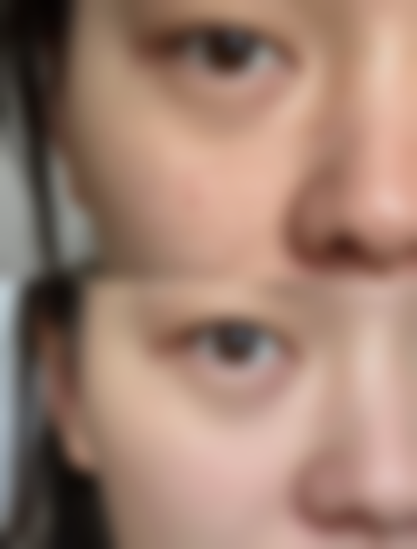 打完正规瘦脸针后的常见副作用及应对方法