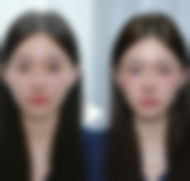 放射疗法修复疤痕疙瘩有什么优势