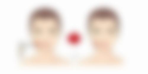 自体脂肪丰太阳穴的过程