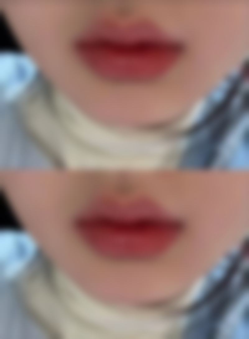 假体隆胸后有什么影响？外观、机能、心理、哺乳、下垂风险全揭秘