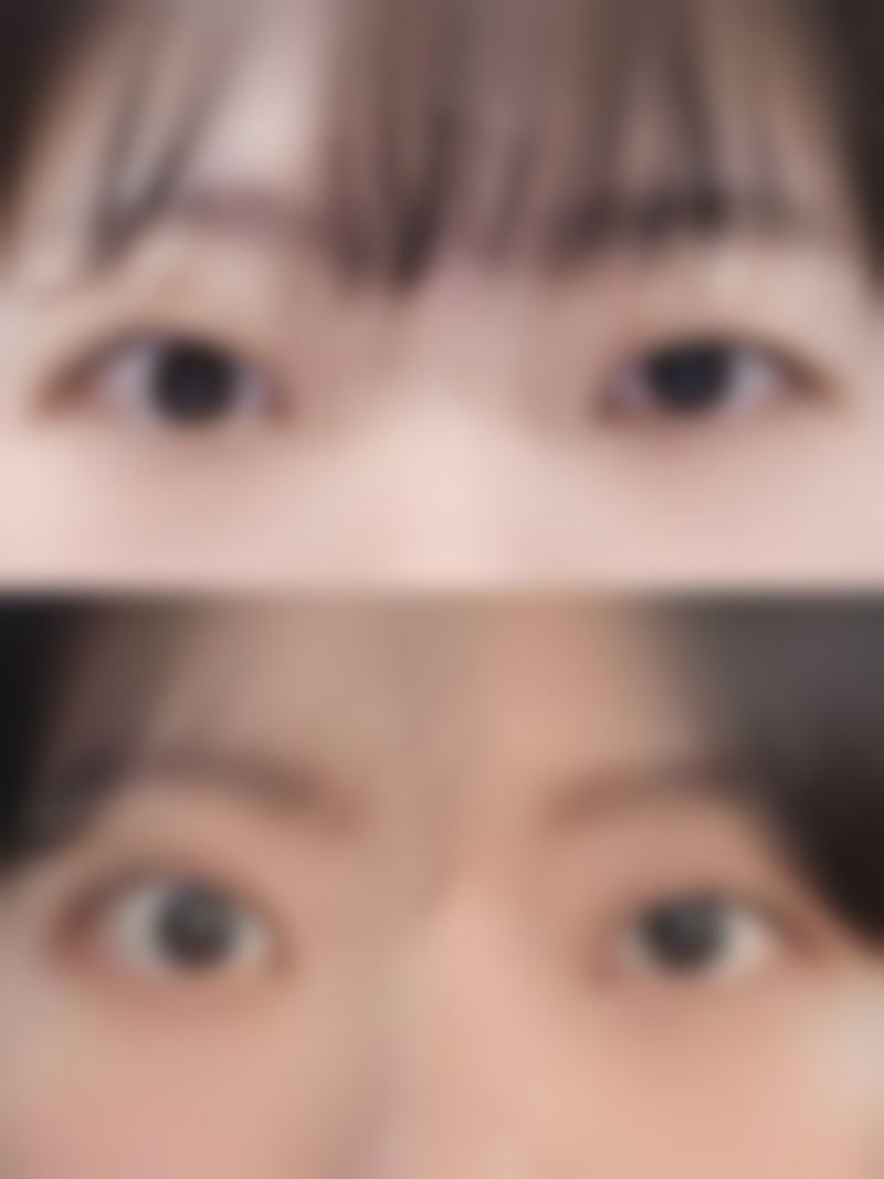 眼部整形手术，如眼部整形等。