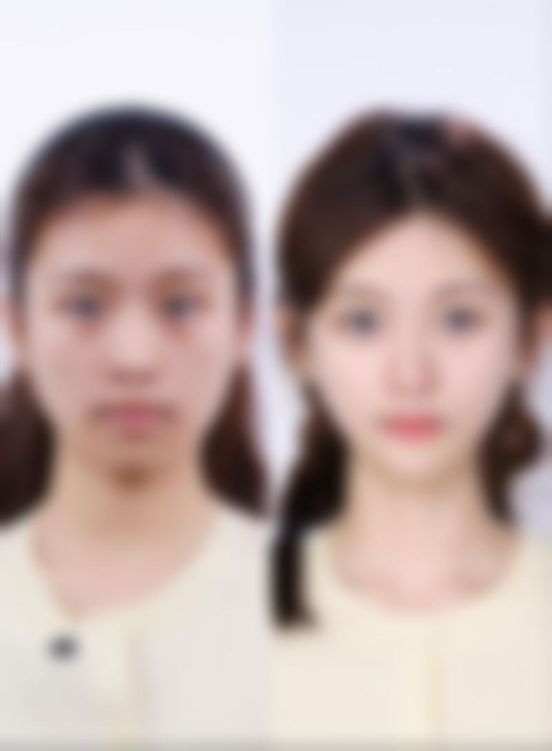 眼部整形手术，如眼部整形手术，如眼部整形手术，如眼部整形手术，如眼部整形手术。