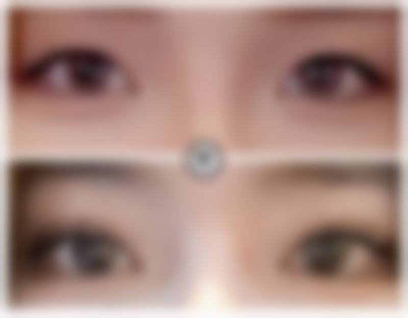 美白针的注射注意事项