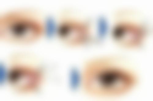 疤痕修复能达到的理想程度