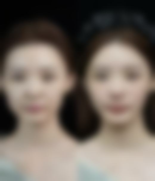 非手术祛眼袋的成效与局限性