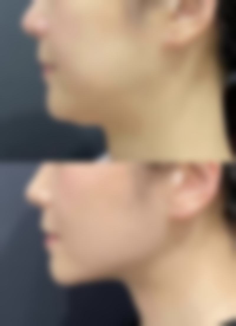 下颌骨整形术可能存在的危险