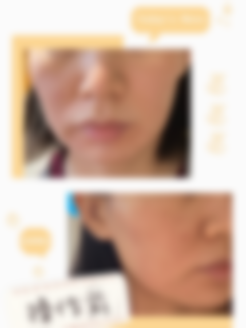 广东韩妃医院半岛超声炮体验如何？蒋水清主任方案加持，中下面部松弛问题轻松改善！ 