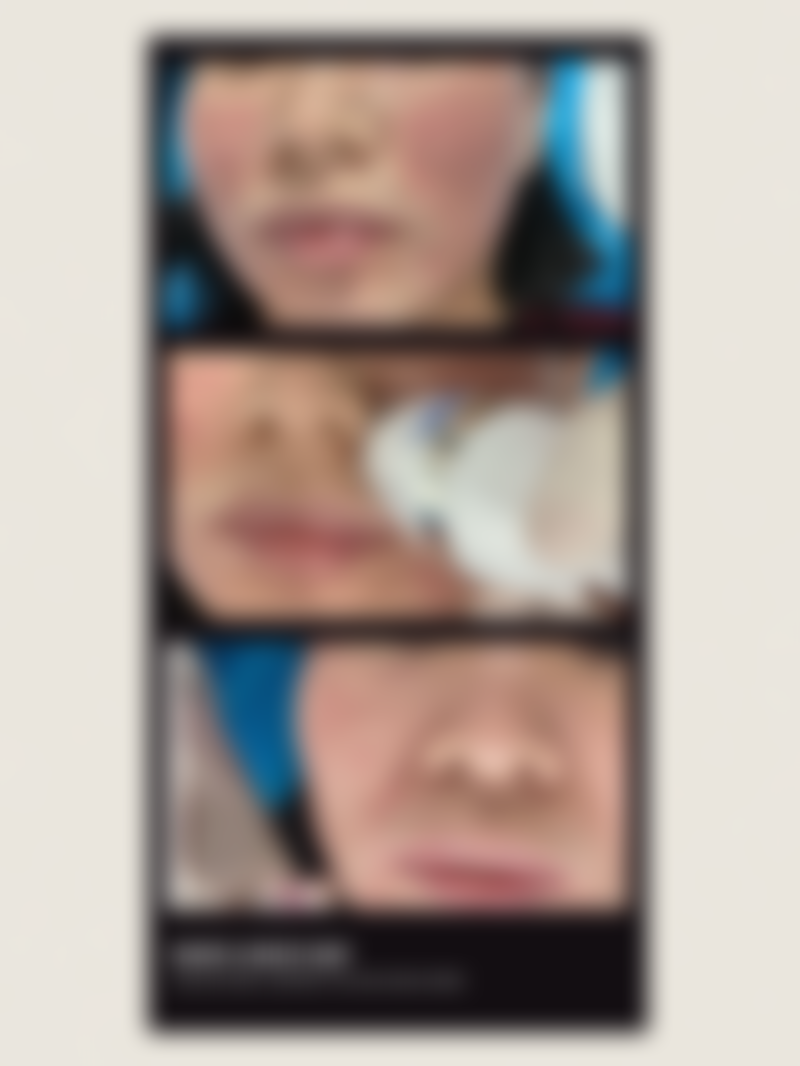 广东韩妃医疗美容医院的半岛超声炮项目,医生是如何选择方案的?