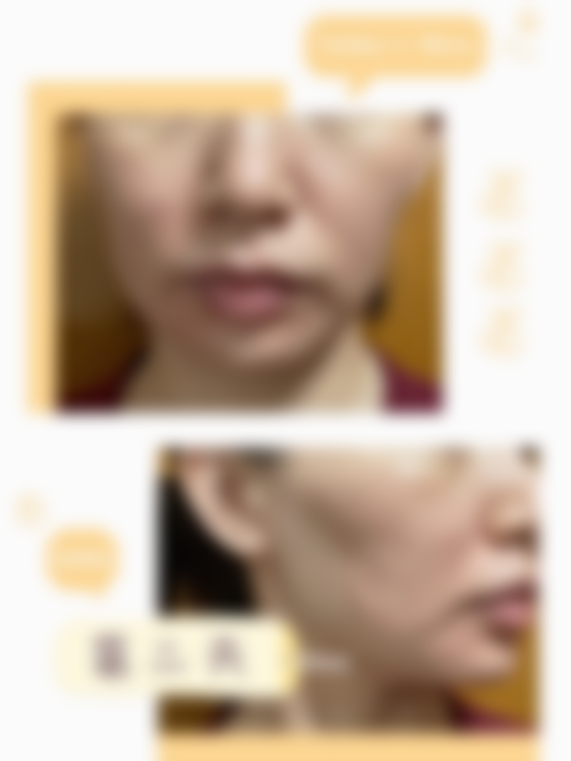 广东韩妃医疗美容医院的半岛超声炮项目体验过程是怎样的?