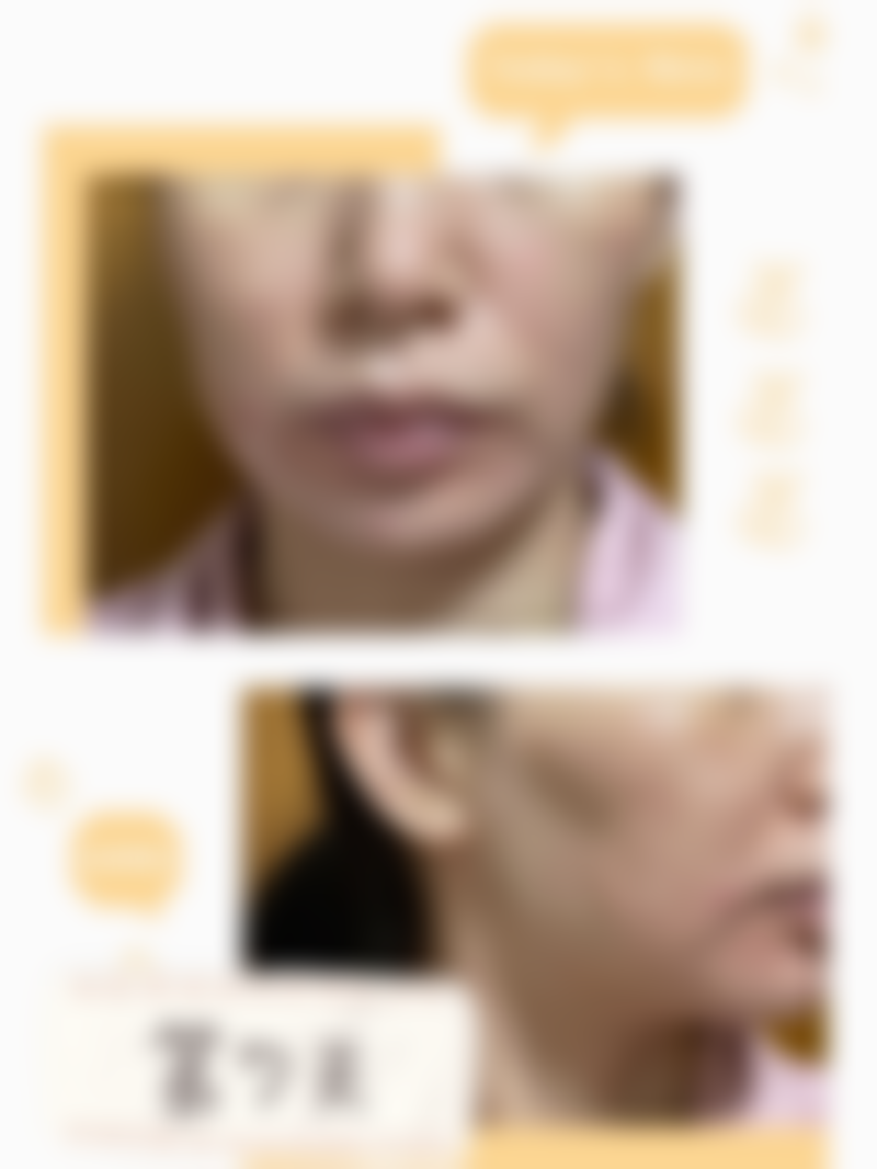 广东韩妃医疗美容医院的半岛超声炮项目体验后成效如何?