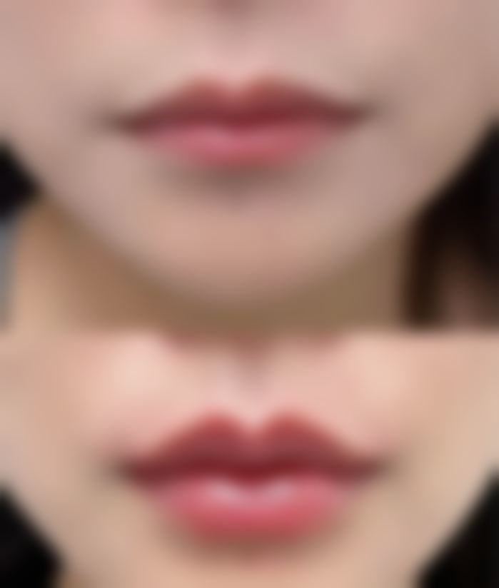 适合不开刀去眼袋的医院推荐